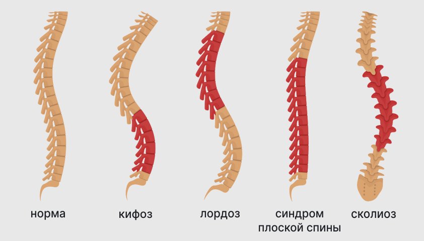 деформирующая дорсопатия - сколиоз, лордоз, кифоз