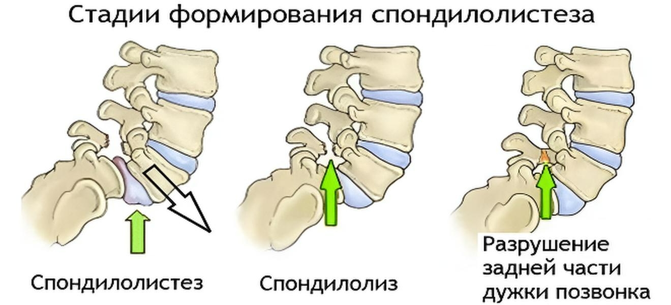 деформирующая дорсопатия -  спондилолистез