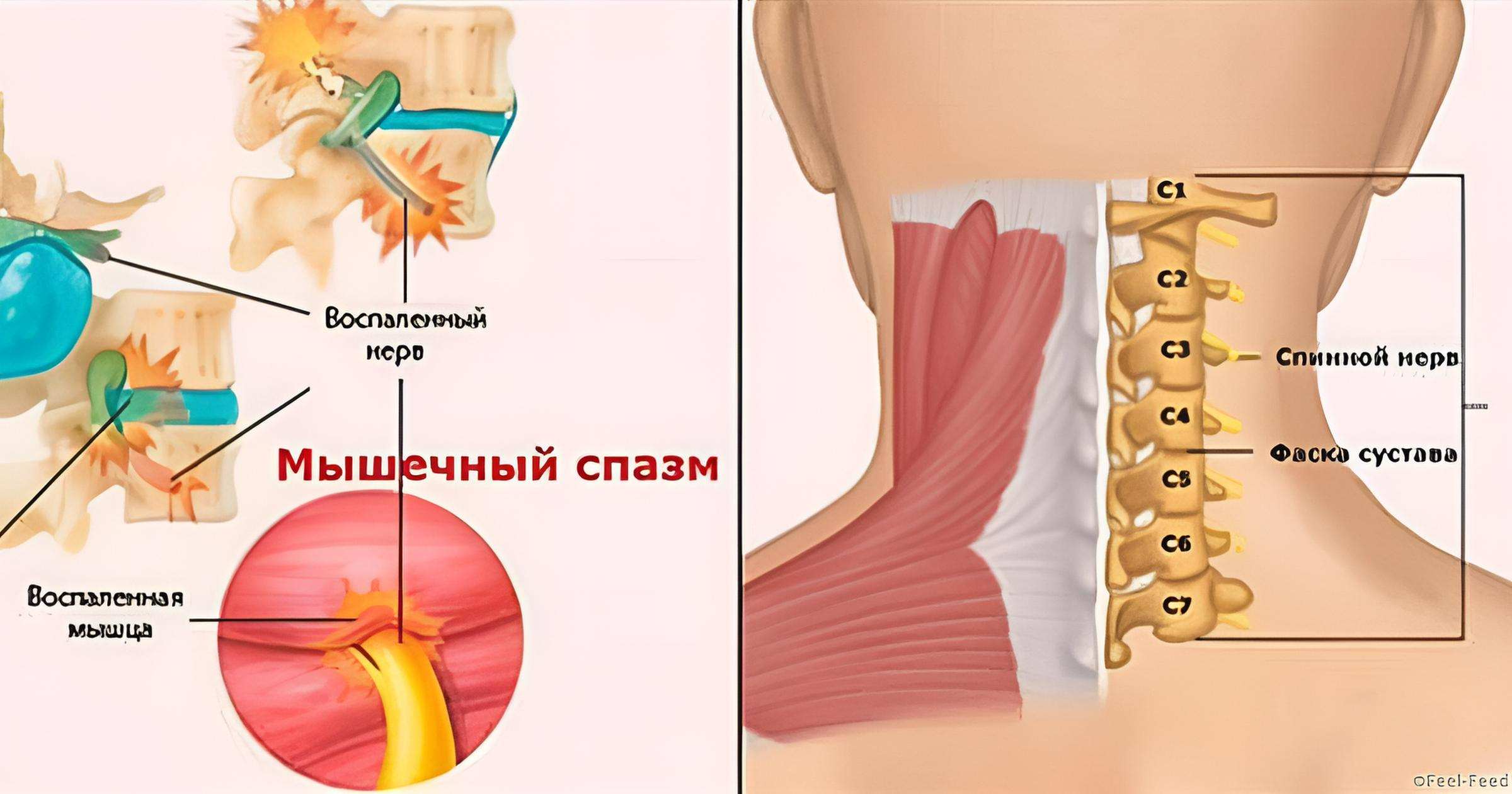 деформирующая дорсопатия - сколиоз, спондилолистез, кифоз